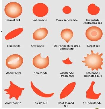 What Is Poikilocytosis .